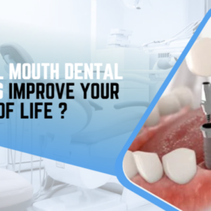 full mouth dental implants