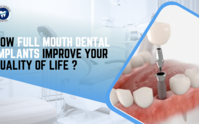 full mouth dental implants